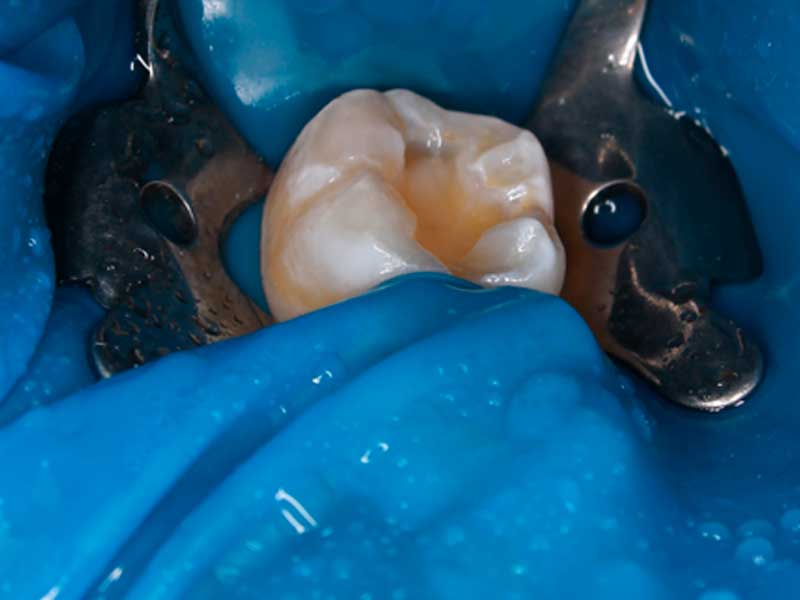 caries-dentista-salina cruz