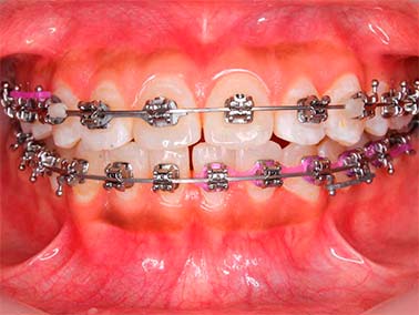 brackets-autoligado-salina cruz