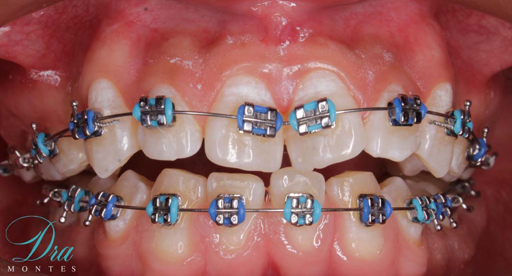 avance-ortodoncia-con-ligas